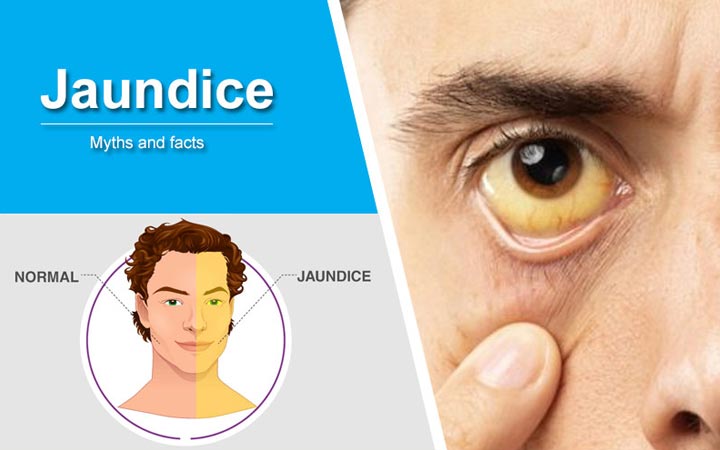 ayurvedic-medicine-for-jaundice-treatment